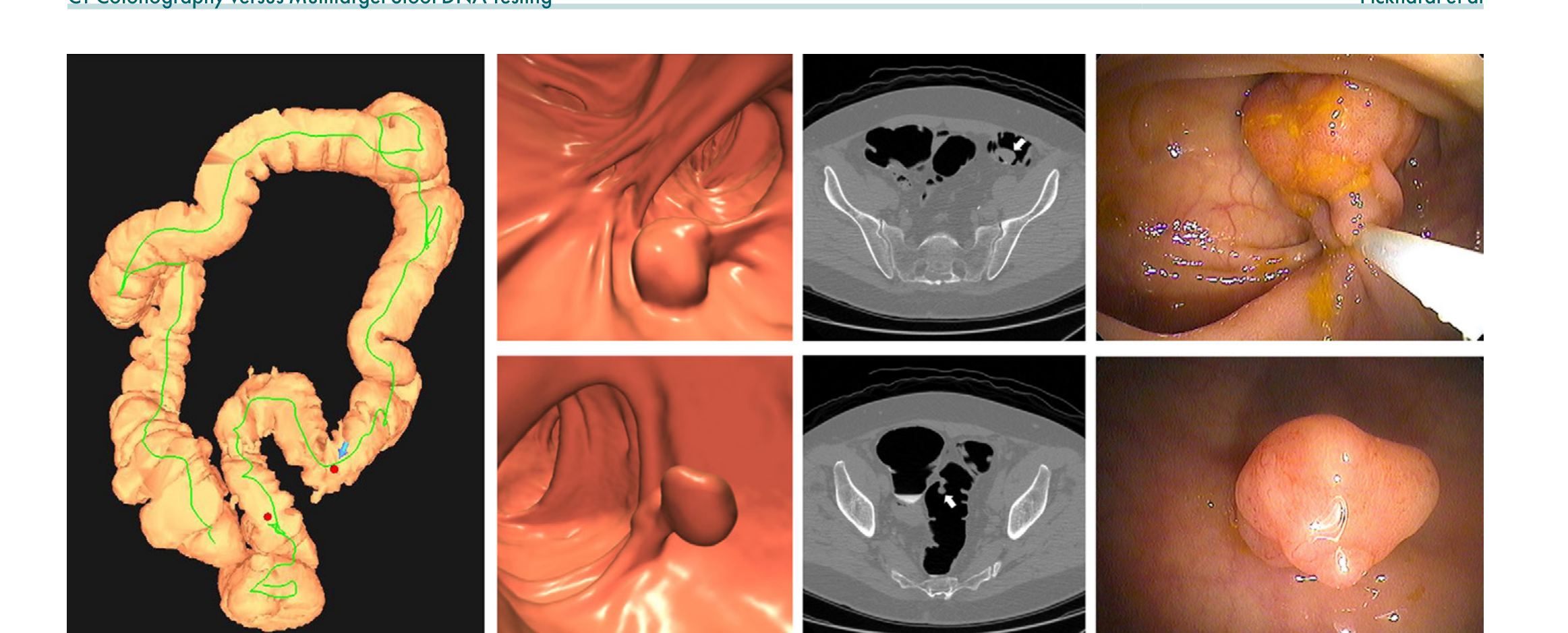 Figure 2: Virtual colonoscopy screening examination images